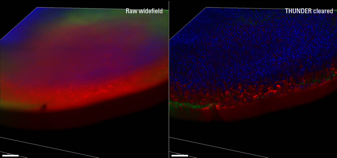  Large FOV 3D oblique view of a 1 mm diameter midbrain neural organoid stained with DAPI (nuclear stain), &beta;‑tubulin (green, neuronal stain), and GFAP (red, astrocyte stain)